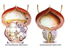 Cât de eficiente de tratament de remedii populare HBP - plante aromatice