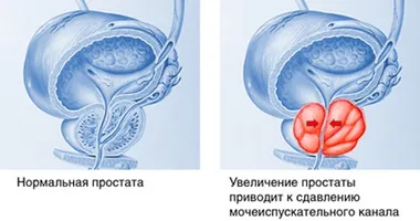 Cât de eficiente de tratament de remedii populare HBP - plante aromatice