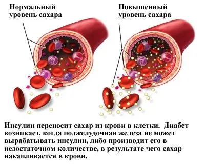 Нормата на инсулин в кръвта - значението на познаването