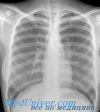 Описание рентгенова снимка на белите дробове