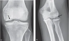 csípő osteochondrosis tünetei és kezelése