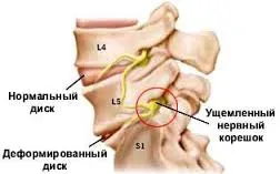 Osteocondrozei a simptomelor coloanei cervicale si de tratament, ceea ce a făcut în timpul exacerbare