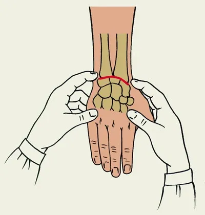 Osteoartrita articulatiei încheietura mâinii - simptome și tratament