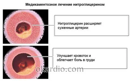 Din ceea ce nitroglicerină ajută angină pectorală, infarct miocardic, insuficiență cardiacă