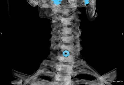 Osteocondrozei a simptomelor coloanei cervicale si de tratament, ceea ce a făcut în timpul exacerbare