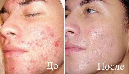 Ózon az arc akne, rosacea és egyéb problémák az arcon