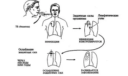 туберкулоза патогенеза