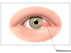 Pinguecula опасност и отстраняване, лечение у дома око