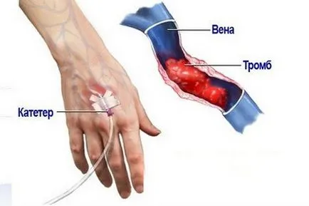 Periflebit tünetei, kezelése és a fotó a betegség tünetei