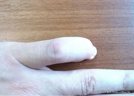 Törés a kis ujját a kezében - tünetek, panaszok diagnosztizálásában és kezelésében, a hetedik mennyországban