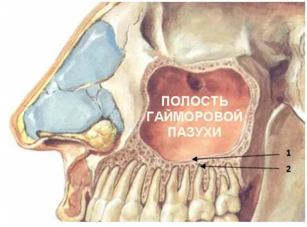 Material de umplere în sinusul maxilar ce să facă și unde să meargă