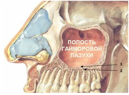 Попълване материал в максиларния синус какво да правят и къде да отида
