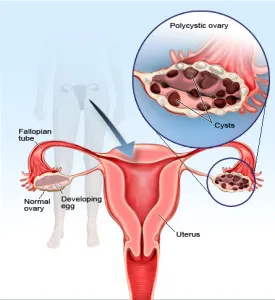 tratament ovare polichistice