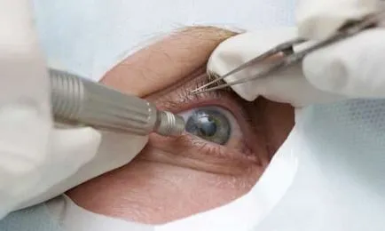 Indicații și contraindicații operația de cataractă