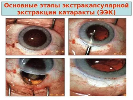 Показания и противопоказания за операция на катаракта, видове операции