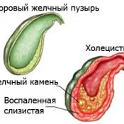 Cauzele vezicii biliare colecistită