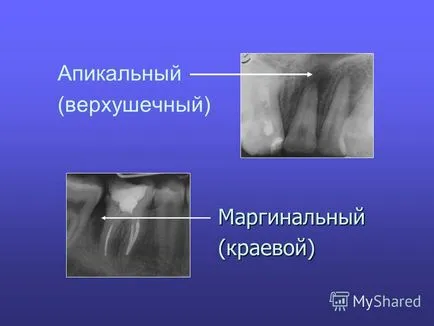 Előadás parodontitisz tejfogainak gyermekek