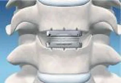 intervertebral disc protetica a coloanei cervicale - Clinica Kassel