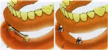 Protézisek implantátumokra segítségével egy kis számú implantátum, tartalom platform