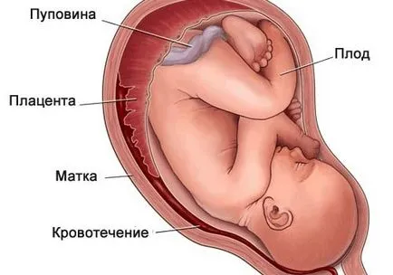 A progeszteron a terhesség aránya, alacsony szinten, és a felesleges hormon