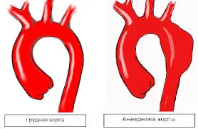 Аортна аневризма ултразвук на сърцето, лечение и диагностика