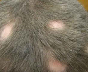 Alopecia areata, alopecia areata cauze si tratament