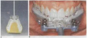 Aksiografiya (kondilografiya) în indicațiile dentare, esența metodei, echipament