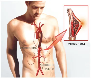 specialiști anevrismului, chirurgie, riscuri