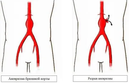 Гръдна аортна аневризма диагностиката и лечението