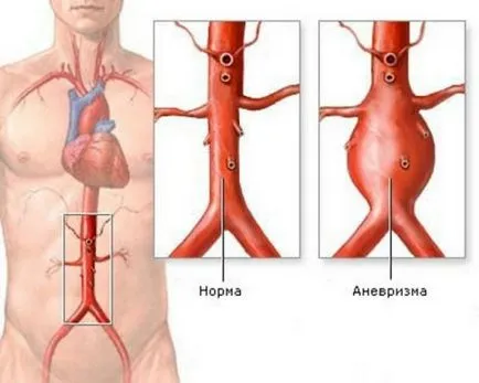 Гръдна аортна аневризма диагностиката и лечението