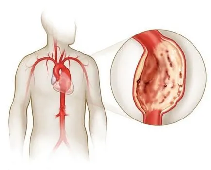 Гръдна аортна аневризма диагностиката и лечението