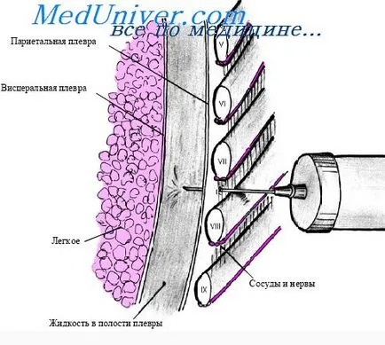 Декатиране плевралната кухина