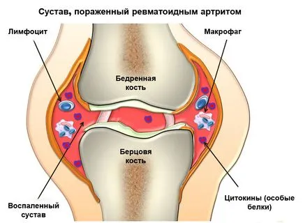 Ревматоиден артрит патогенеза, етиология