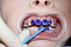 Ezüstös fogak fotó a gyermekek, különösen eljárások