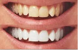 Antera - antalya - clinica dentara - dentist - sănătate orală și dentară - implant, Cene cerrahi, LARA,