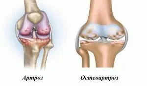 Osteoarthritis és osteoarthritis különbség és hasonlóság