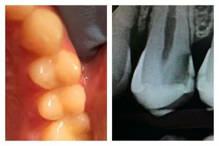 interproximalis fogszuvasodás