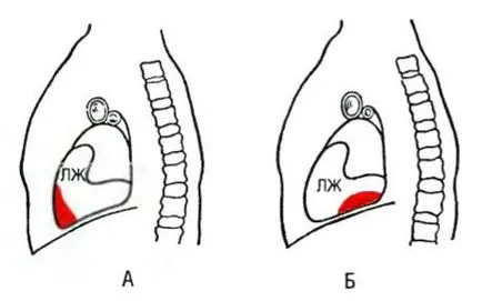 A transzmurális ischaemia és a miokardiális infarktus