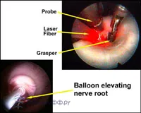 recenzii pentru indepartarea cu laser a coloanei vertebrale hernie spun despre rezultate uimitoare!