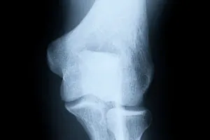 Tuberculoza articulației genunchiului (conducere)