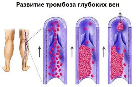 Дълбоки венозна тромбоза причини и лечение на долен крайник