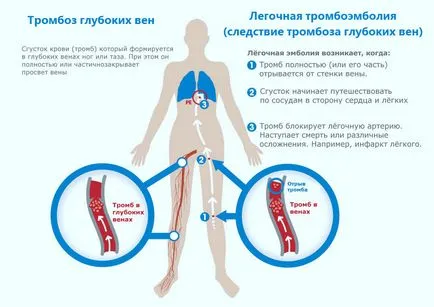 Cauzele profunde tromboză venoasă și tratamentul membrelor inferioare