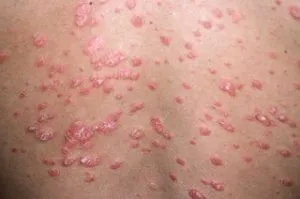 Psoriasis bakteriális elmélet betegség