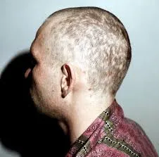 Caderea parului la sifilis (alopecie, alopecie)