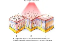 Дали епилация вредно