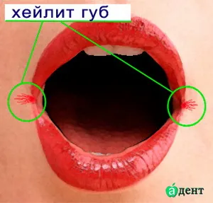 Хейлит - Симптоми, причини, лечение и диагностика