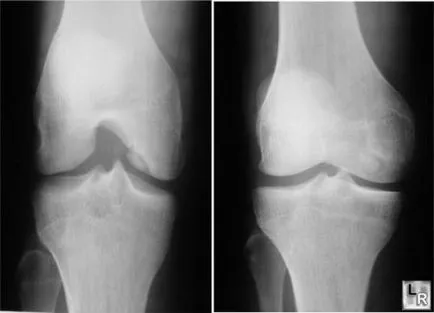 Chondrosis okoz tüneteket, kiterjedését és következményeinek kezelésére