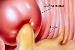 Хронична гонорея при жените