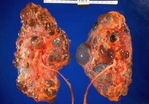 Cronica CKD boli de rinichi sau 1 2 3 4 5 etape și gradul de diagnosticare a bolilor cronice