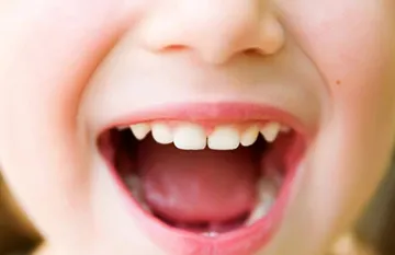 Ulcer în gură - tratament medical și la domiciliu
